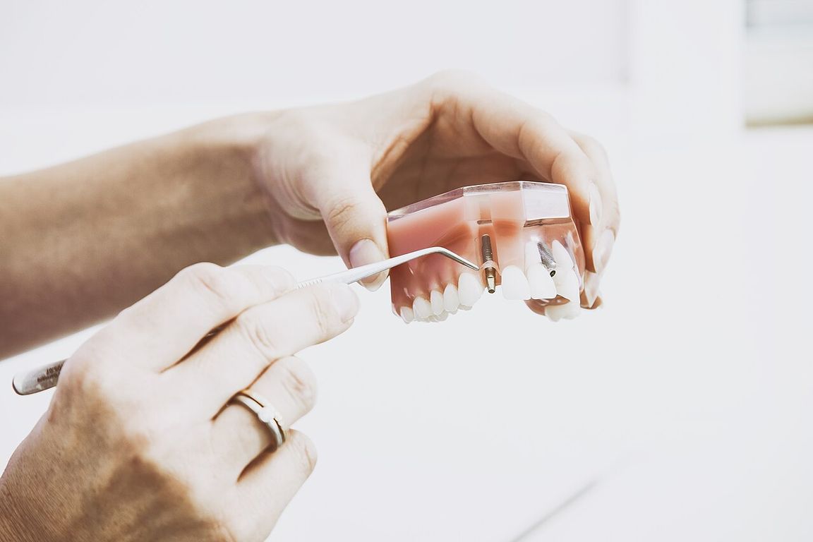 Dental implant model and modern treatment equipment